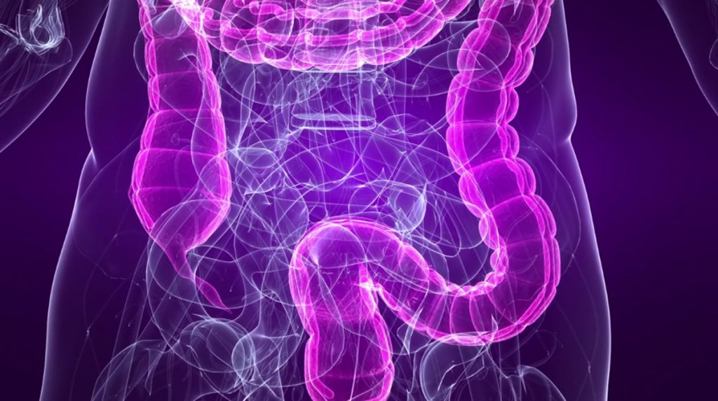 Síndrome del intestino irritable (SII): Un diagnóstico erróneo de endometriosis común