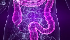Síndrome del intestino irritable (SII): Un diagnóstico erróneo de endometriosis común