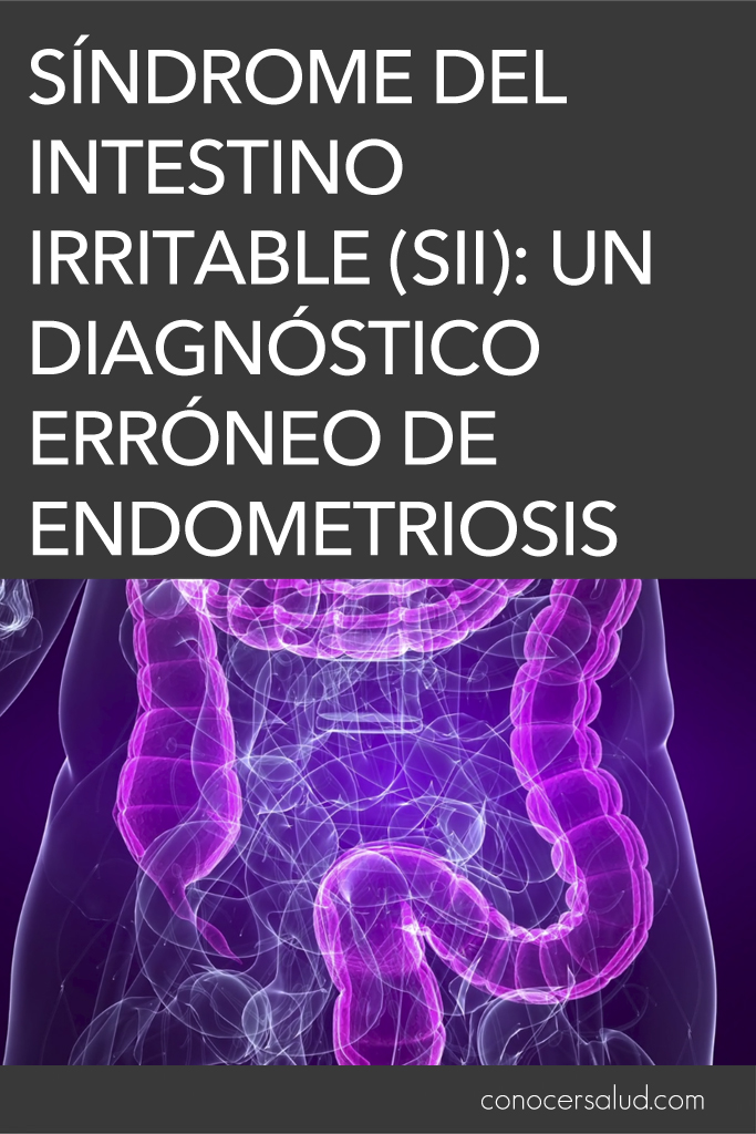 Síndrome del intestino irritable (SII): Un diagnóstico erróneo de endometriosis común