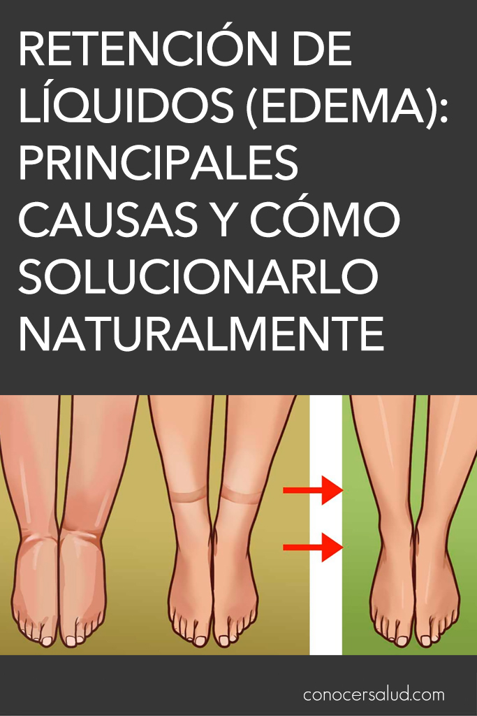 Retención de líquidos (edema): principales causas y cómo solucionarlo naturalmente