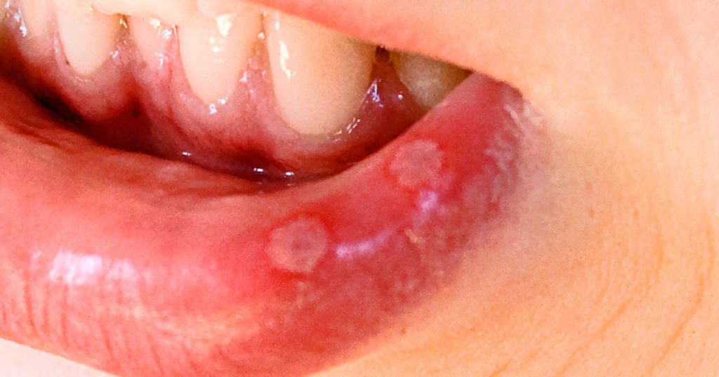 3 causas principales de las úlceras bucales y algunos consejos que podrían ser útiles
