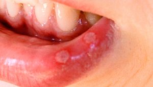 3 causas principales de las úlceras bucales y algunos consejos que podrían ser útiles