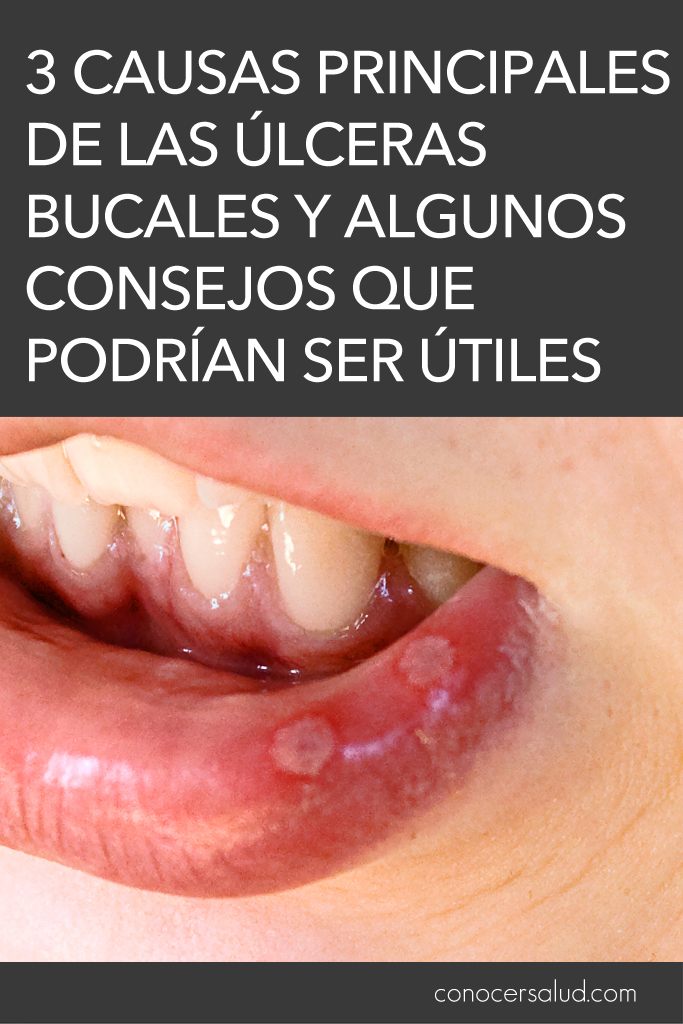 3 causas principales de las úlceras bucales y algunos consejos que podrían ser útiles