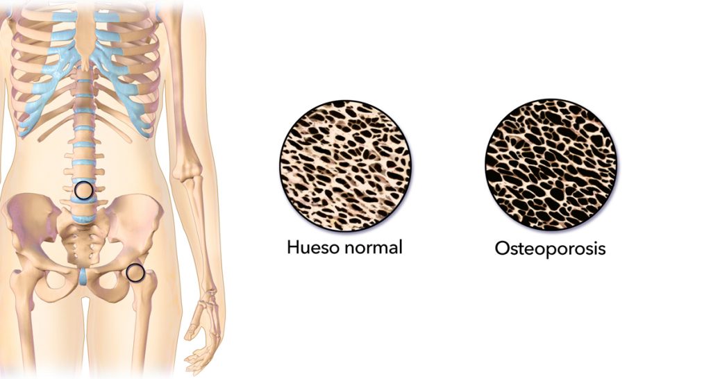 12 Causas de la osteoporosis y la pérdida de hueso que debe saber