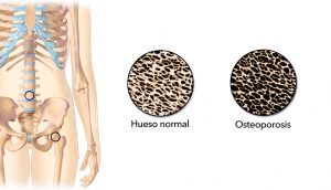 12 Causas de la osteoporosis y la pérdida de hueso que debe saber