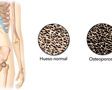 12 Causas de la osteoporosis y la pérdida de hueso que debe saber
