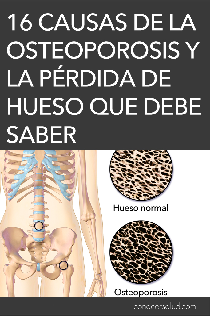 16 Causas de la osteoporosis y la pérdida de hueso que debe saber