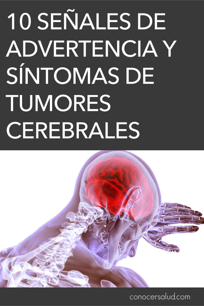 10 señales de advertencia y síntomas de tumores cerebrales que debe saber