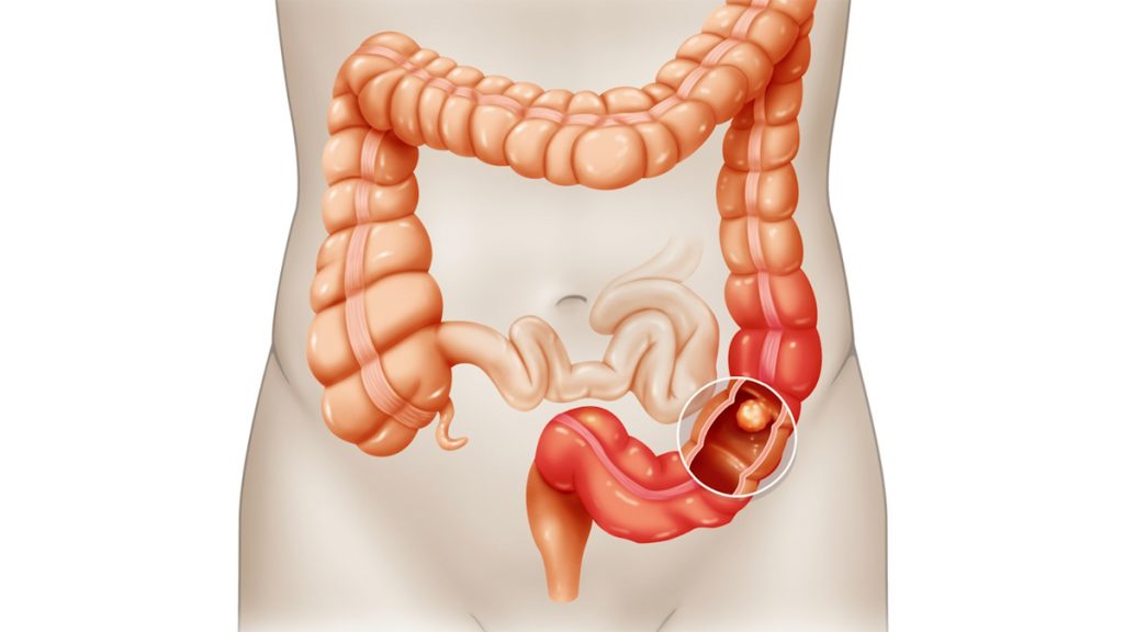 5 Síntomas del cáncer colorrectal y 7 Factores de riesgo