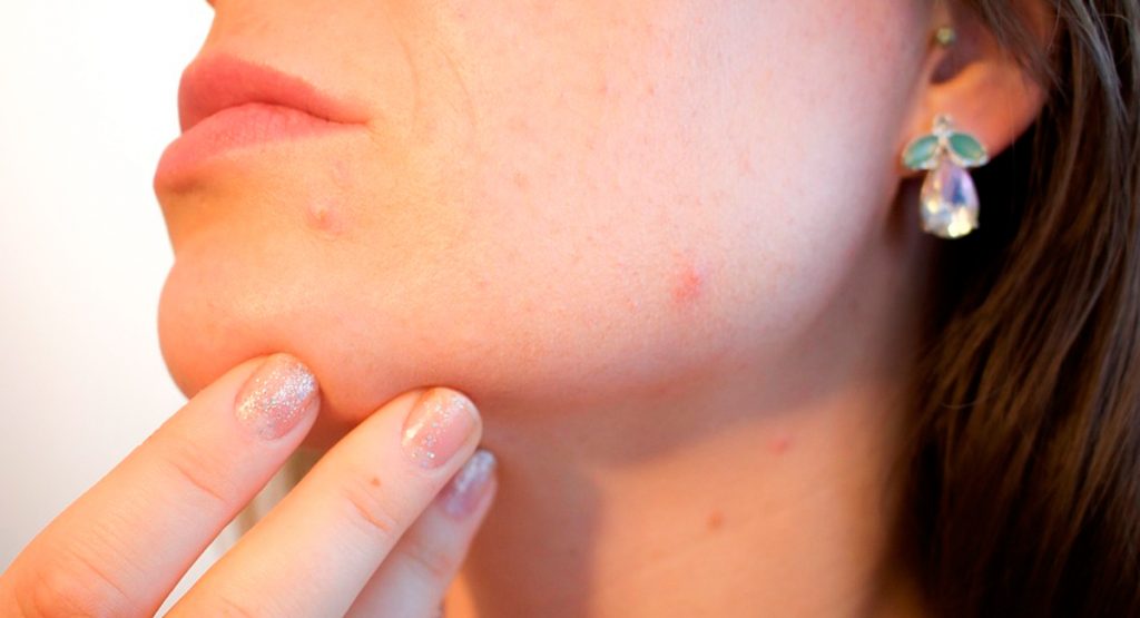 7 maneras eficaces de deshacerse de las cicatrices del acné