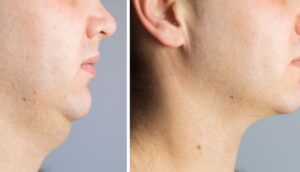 3 Ejercicios eficaces para perder la grasa del cuello y la cara