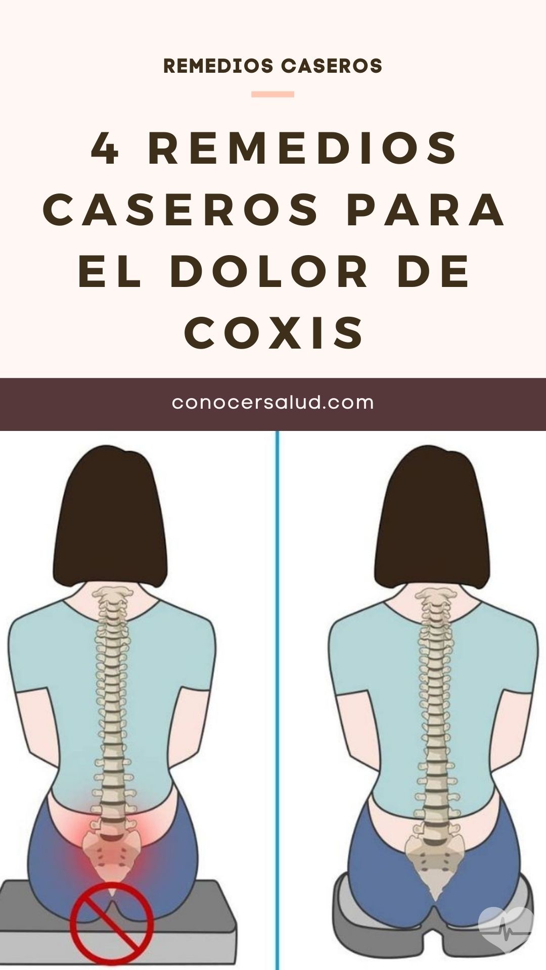 4 Remedios caseros para el dolor de coxis (coxigodinia)