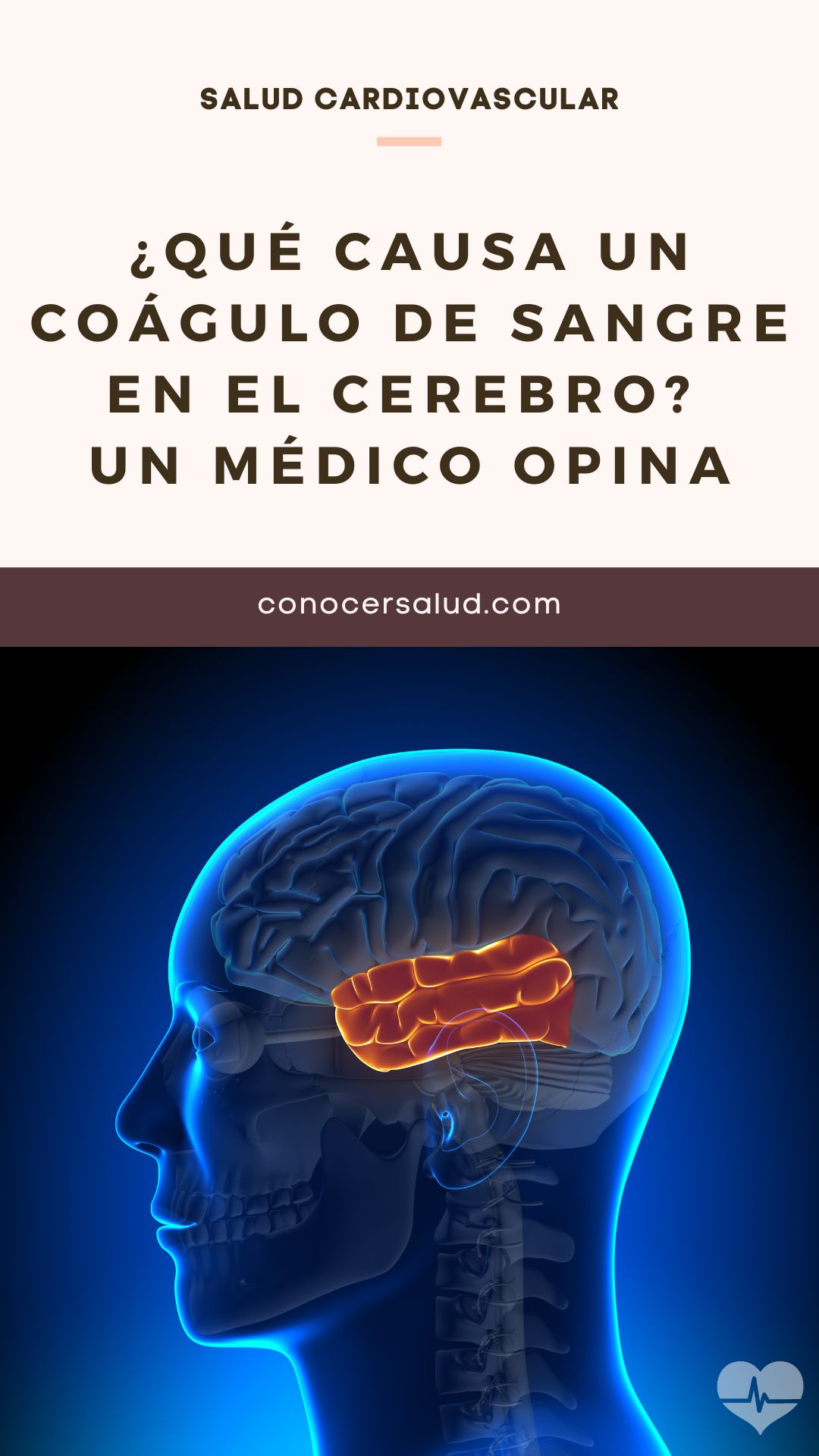 ¿Qué causa un coágulo de sangre en el cerebro? Un médico opina