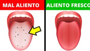 10 Formas de curar el mal aliento en casa