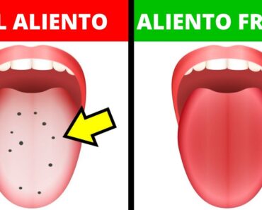 10 Formas de curar el mal aliento en casa