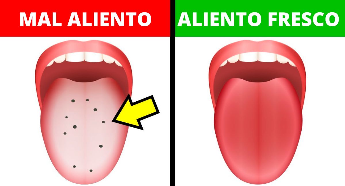 10 Formas de curar el mal aliento en casa