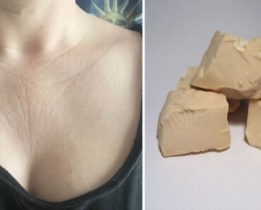 Mascarilla de levadura para eliminar las arrugas del cuello y del pecho Mascarilla de levadura para eliminar las arrugas del cuello y del pecho