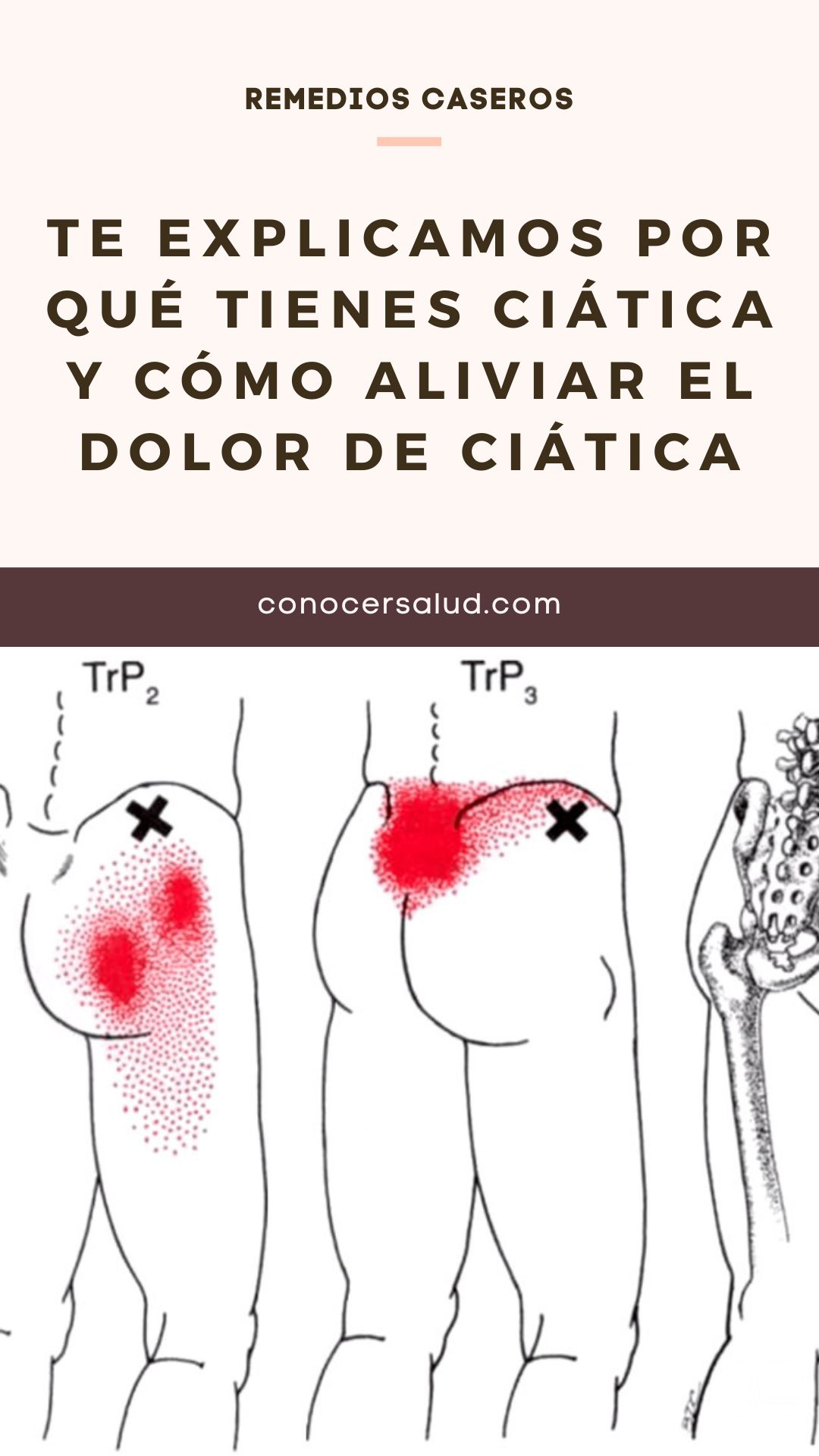 Te explicamos por qué tienes ciática y cómo aliviar el dolor de ciática