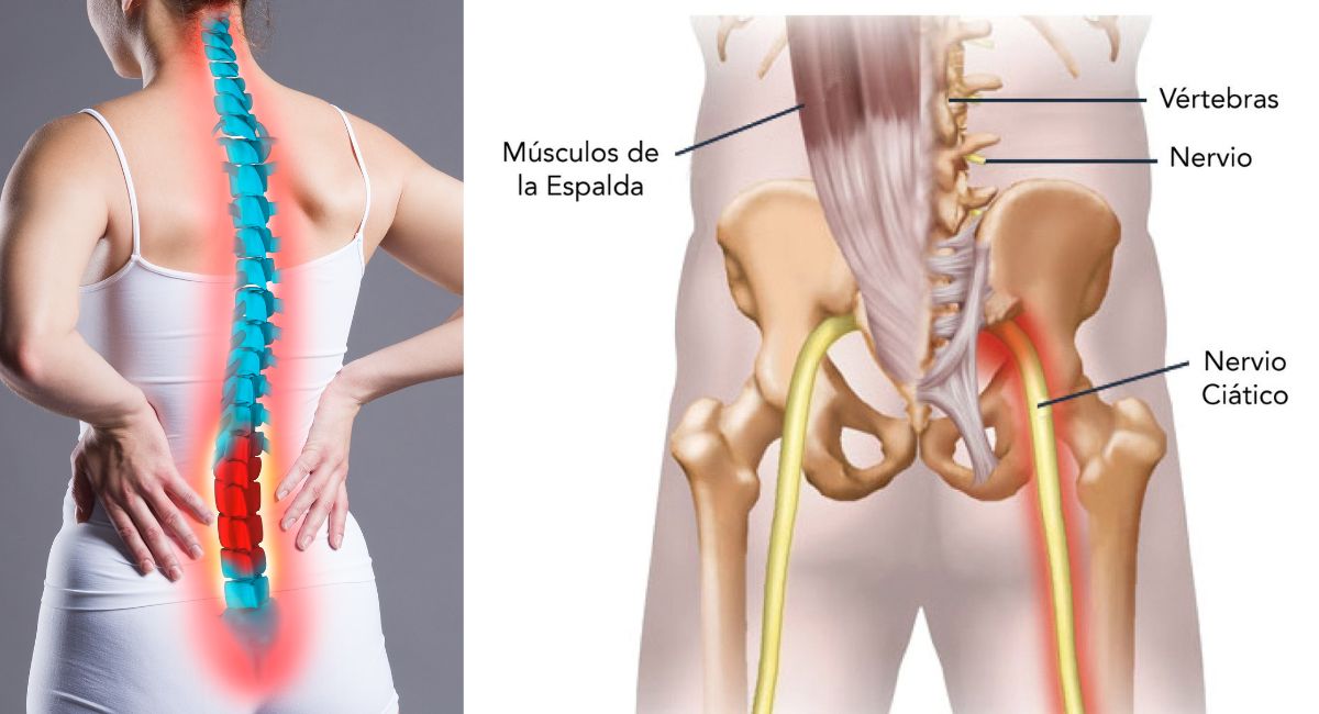 Te explicamos por qué tienes ciática y cómo aliviar el dolor de ciática