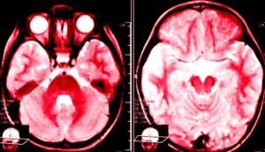 Efectos del alcohol en el cerebro: cómo actúa el alcohol en el cerebro