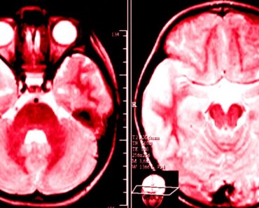 Efectos del alcohol en el cerebro: cómo actúa el alcohol en el cerebro