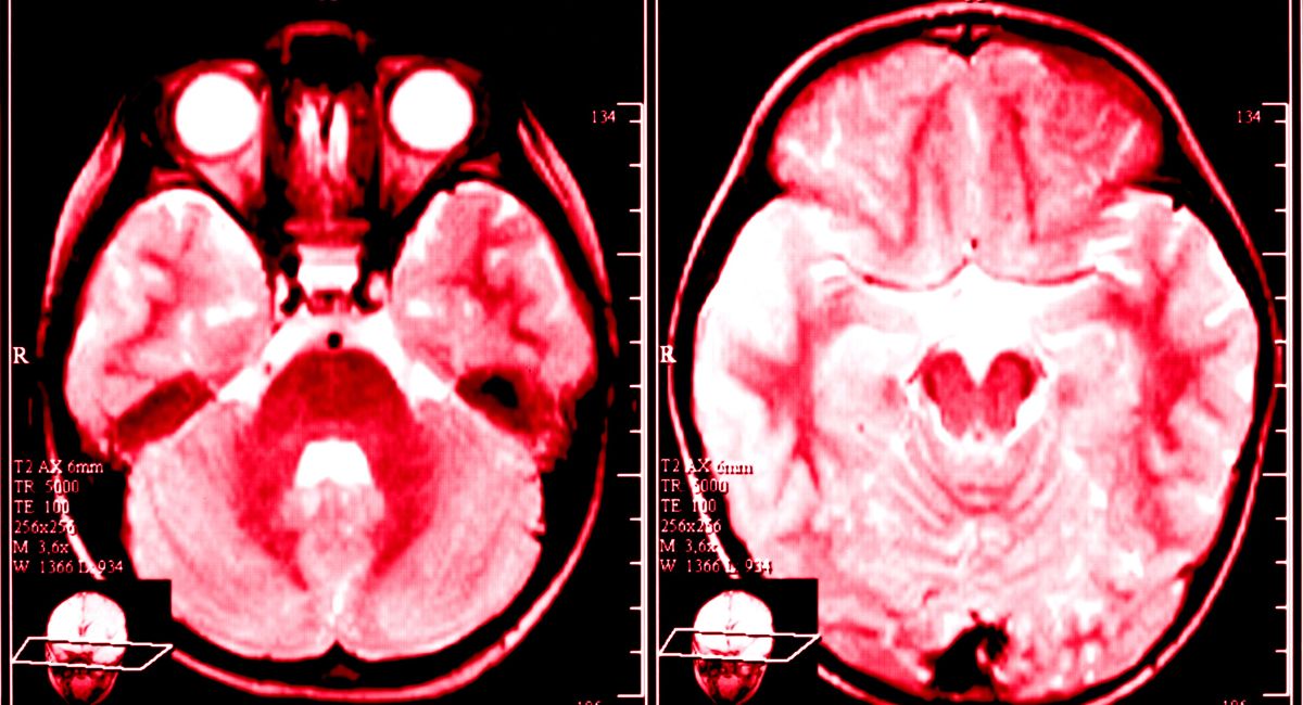 Efectos del alcohol en el cerebro: cómo actúa el alcohol en el cerebro