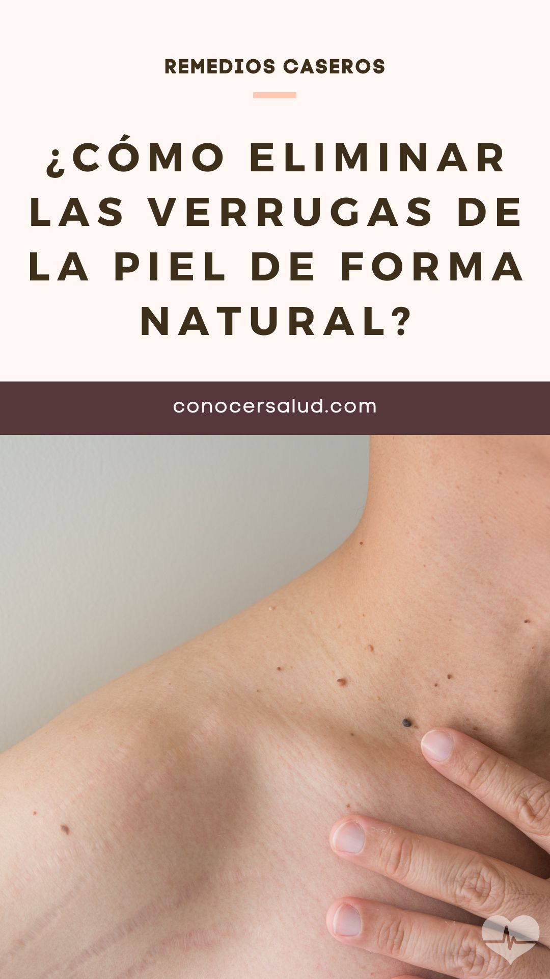 ¿Cómo eliminar las verrugas de la piel de forma natural?